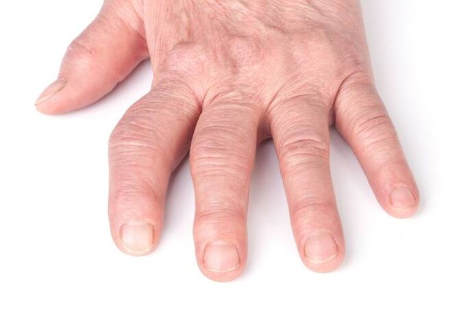 Deformed joints in the hands