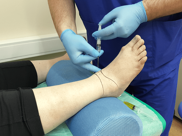 Ankle Arthropathy Puncture