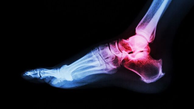 Ankle joint disease