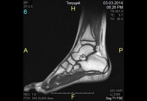 Arthropathy of the ankle image