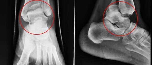 Radiology of the ankle