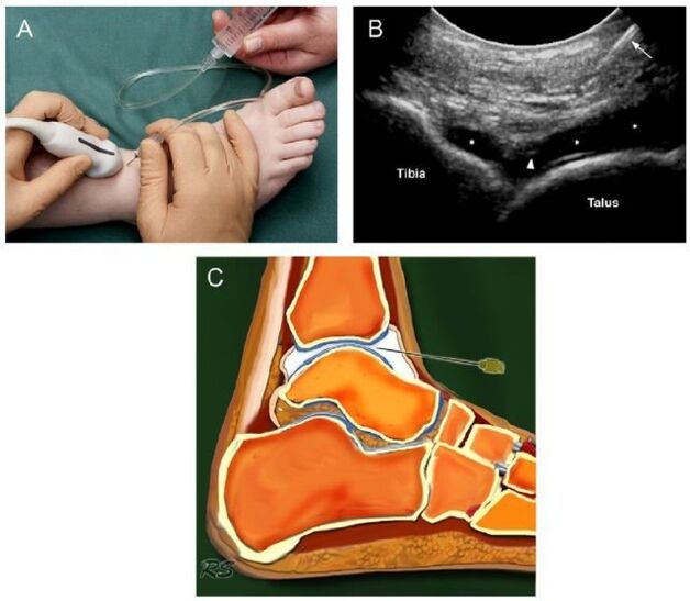 Ultrasound of the ankle joint related to joint disease