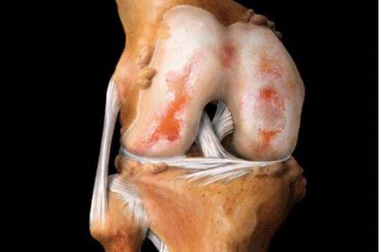 Damage to the knee joint by arthropathy