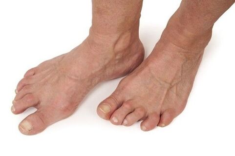 Feet affected by arthropathy
