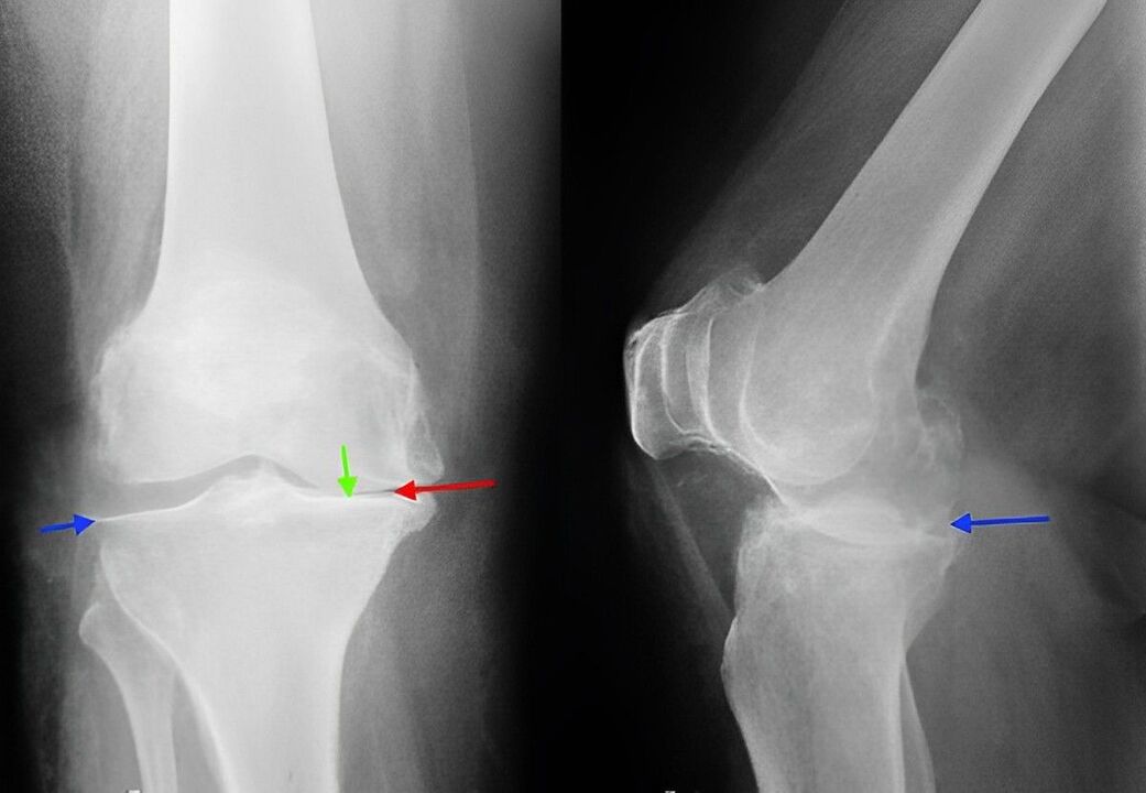 X-rays for knee arthritis