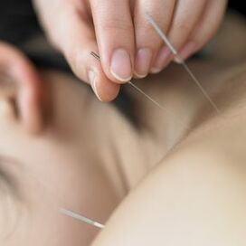 acupuncture