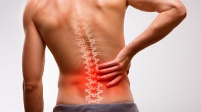 Signs and symptoms of lumbar osteochondrosis