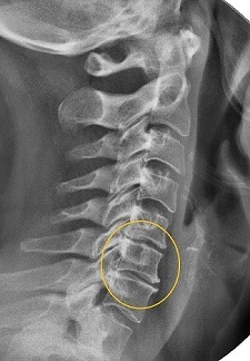 Narrow the intervertebral space on X-rays