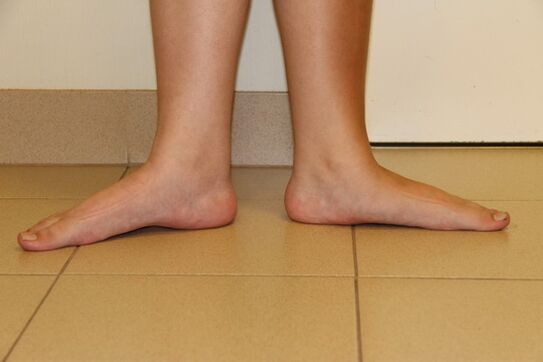 Sometimes neck arthritis is caused by flat feet