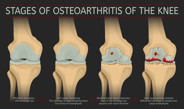 Development of joint arthritis