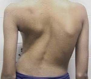 Scoliosis is the cause of back pain
