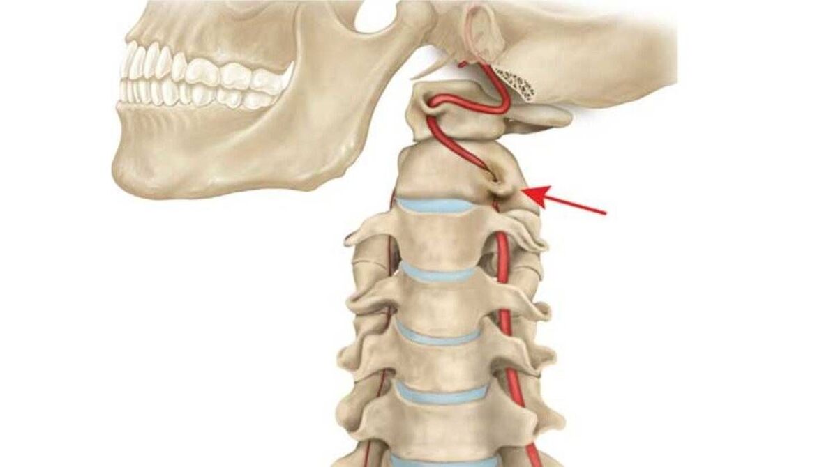 cervical osteochondrosis