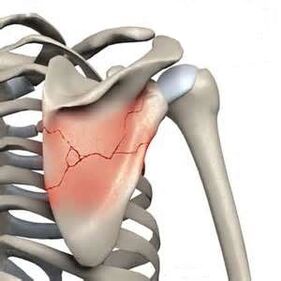 Shoulder blade fractures are one of the causes of severe pain.