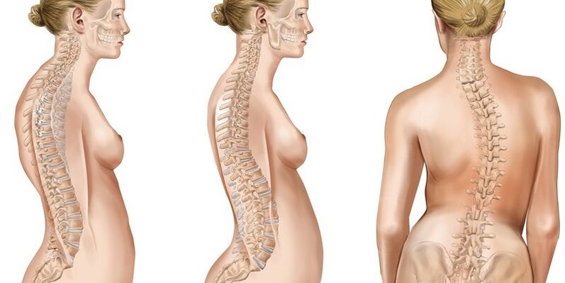 Thoracic scoliosis can cause scapula pain