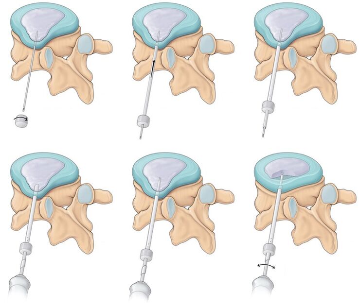 back pain surgery