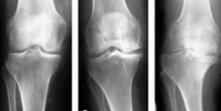 Knee arthritis 3rd degree