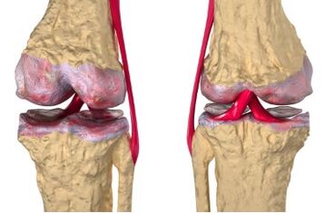 Varicose veins are the cause of knee joint disease