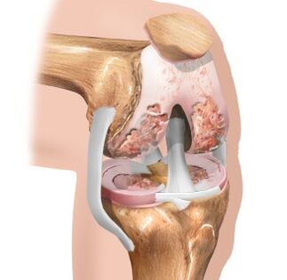 cartilage wear