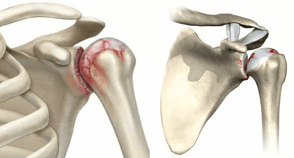 What does the arthropathy of the shoulder joint look like 