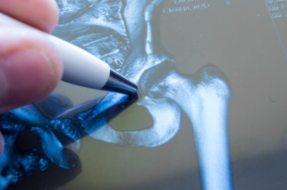 Arthropathy of the hip on X-ray