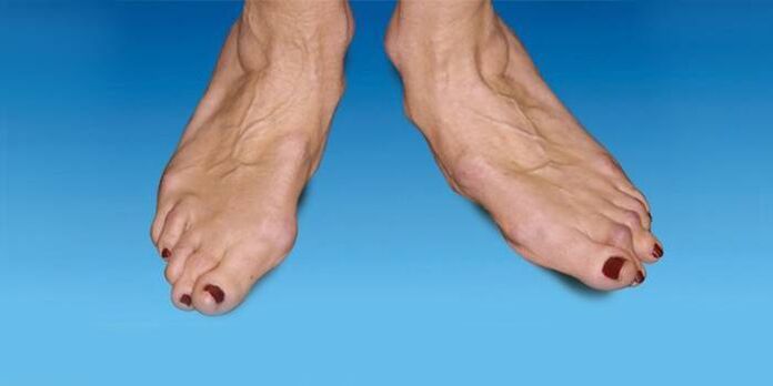 Ankle Deformity Foot Deformity