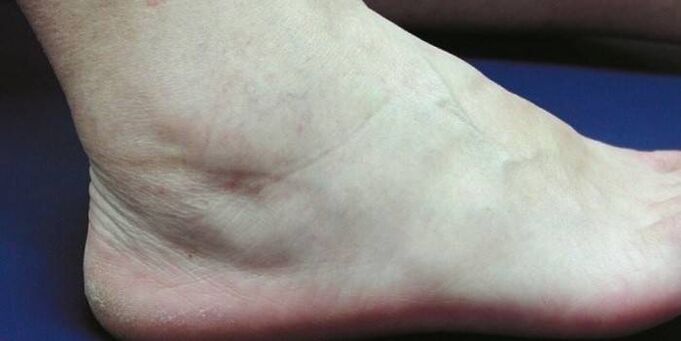 Swollen ankles with arthropathy