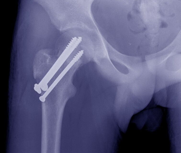 X-rays of hip joints, fractures and osteosynthesis and internal fixation devices